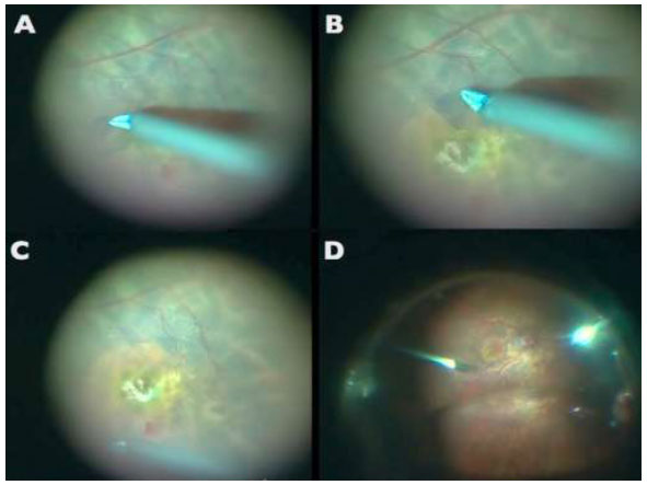 Retina Clínica e Cirurgica - Dra. Juliana Prazeres